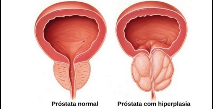síntomas de hiperplasia prostática benigna en hindi