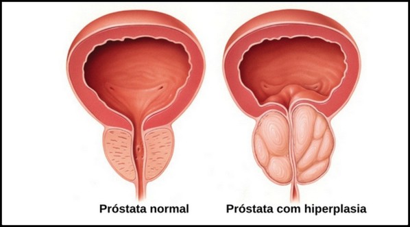 síntomas de cáncer de próstata bphum