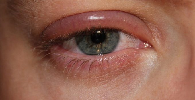 Ojos hinchar los cómo hinchados de