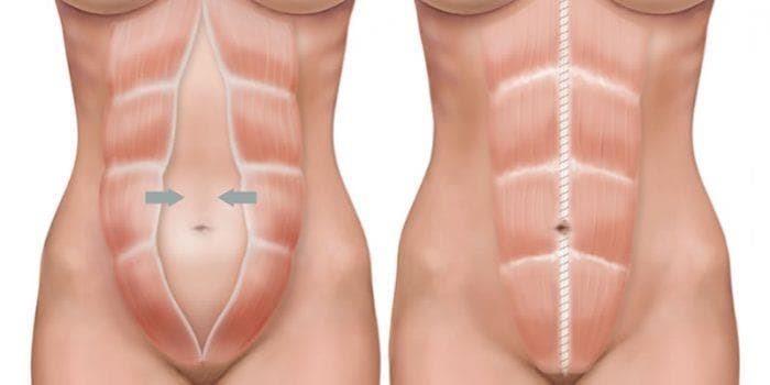 como se cura el ombligo despues de una abdominoplastia como se cura el ombligo despues de una abdominoplastia